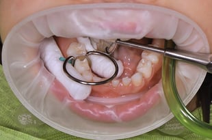 Restoring a deciduous tooth under relative isolation