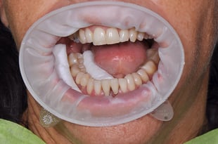 Occlusal filling on tooth 46 under relative isolation