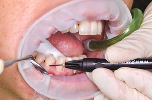 Class V filling on tooth 44 under relative isolation