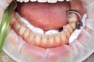 Colocar una corona parcial sobre el diente 36 con aislamiento relativo