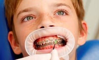 A flowable fluoride varnish protects difficult-to-reach areas of the teeth, for example, in orthodontic patients.