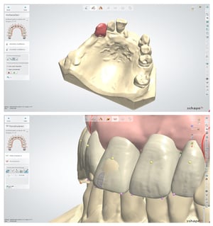 Digital Denture software